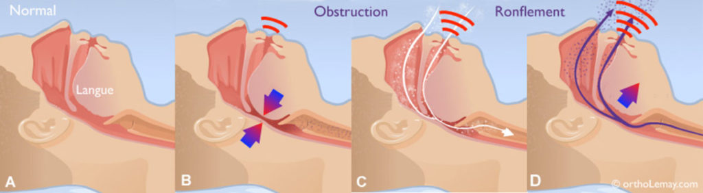 Problème de ronflement • La clinique du sommeil