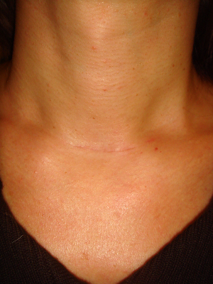 cicatrice thyroide