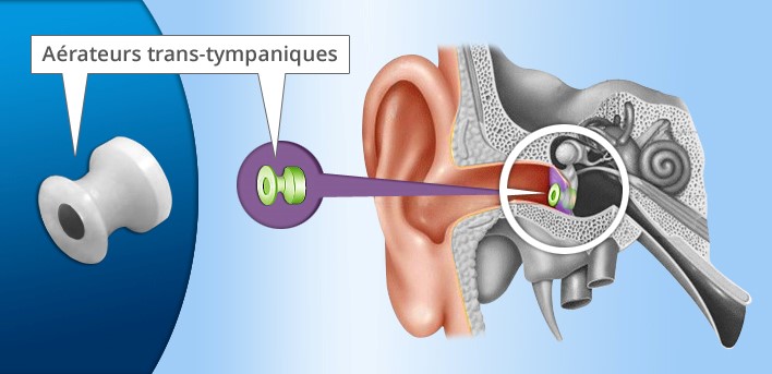 Trompe d'Eustache : anatomie, pathologies, traitements