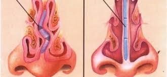 Traitement ORL des pathologies du nez et des sinus | ORL 31